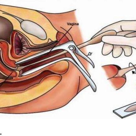 宫颈刮片的视频,直观展示女性健康守护